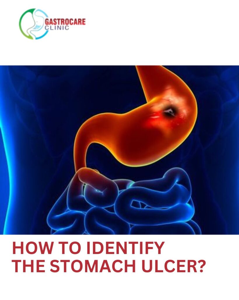 Wondering how to identify a stomach ulcer? Learn the key symptoms and when to consult a stomach specialist in Sangli for early diagnosis and effective treatment.